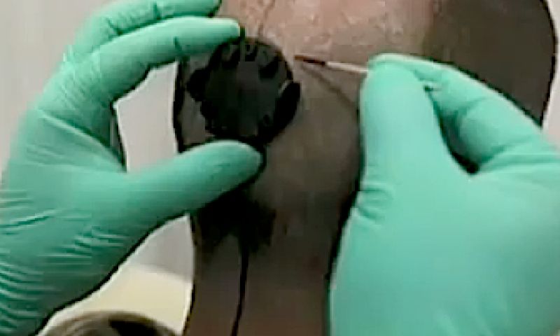 Professor laat camera in achterhoofd implanteren