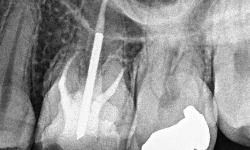 Zelfhelende vulling geneest en repareert wortelkanaal