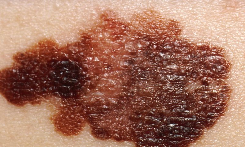 AI-systeem net zo goed in herkennen huidkanker als deskundigen