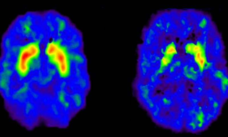 Ook complexe gedachten nu te decoderen met hersenscan