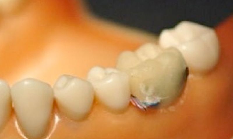 Bluetooth kroon, binnenkort bij de tandarts verkrijgbaar?