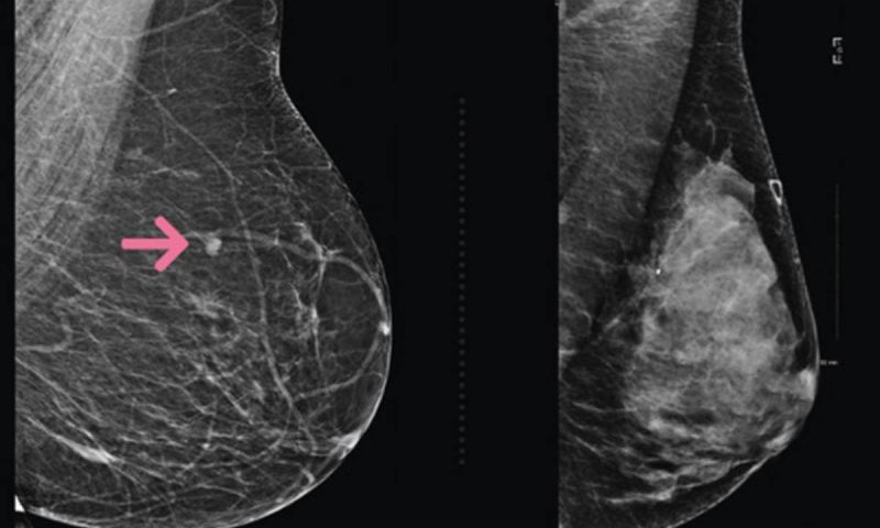 MIT AI voorspelt borstkanker aanzienlijk nauwkeuriger