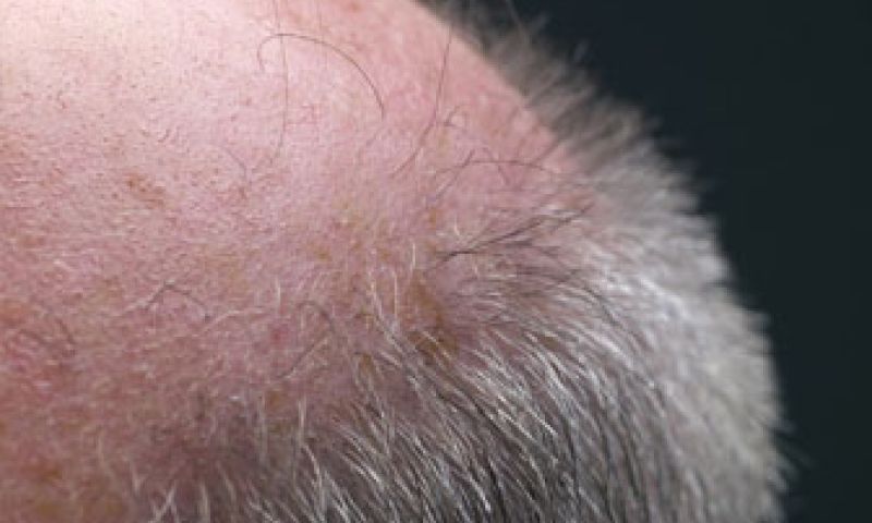 Hormoon tegen kaalheid gevonden