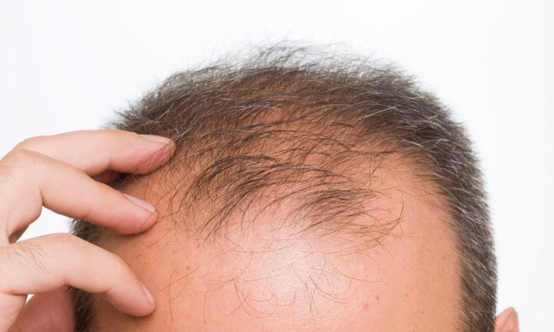 Stamcelmiddel helpt haargroei bij kaalheid